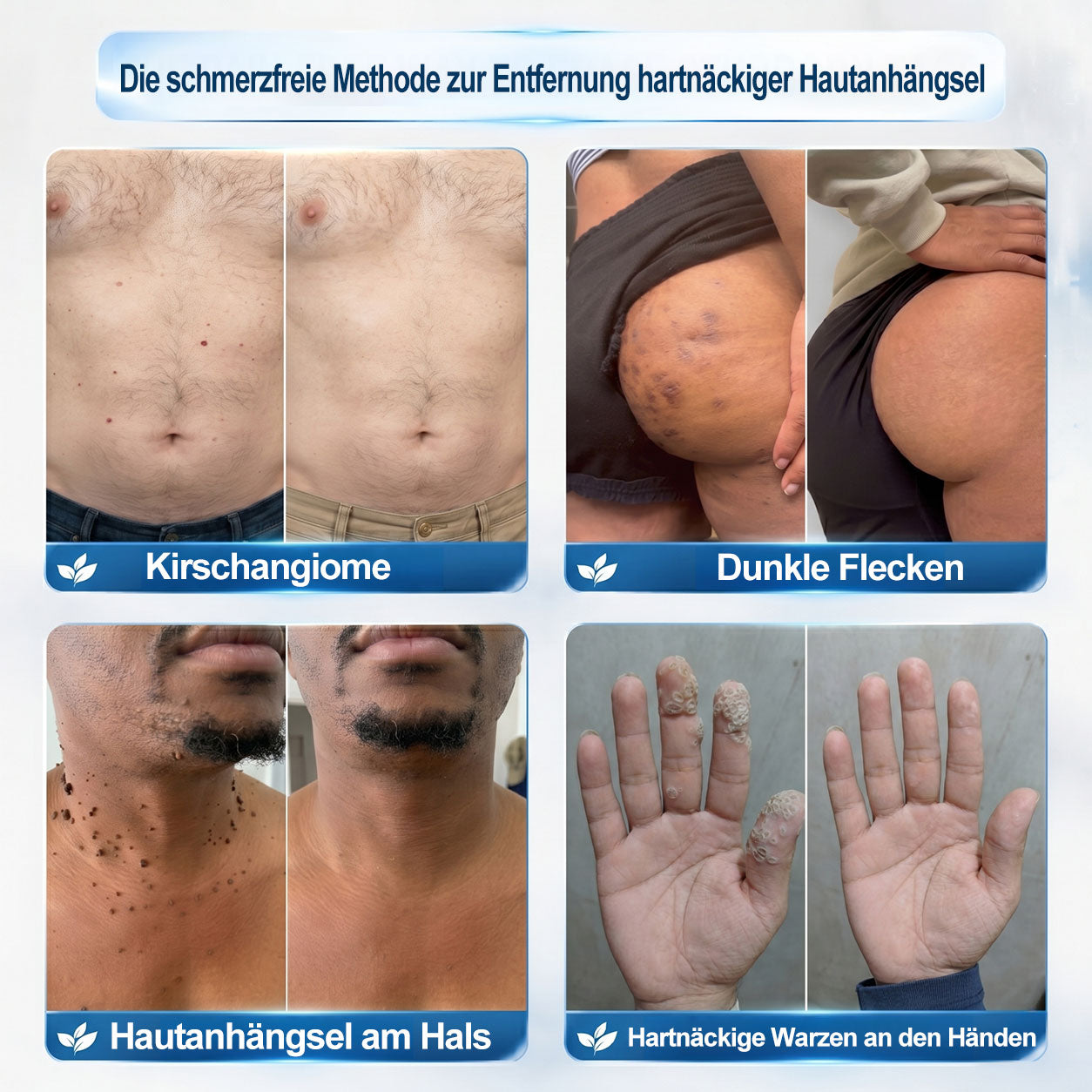 Offizieller Markenstore |✅𝑷𝑖𝒄𝐝𝐨® 7-𝑻𝒂𝒈𝒆 𝑯𝒂𝒖𝒕𝒂𝒏𝒉ä𝒏𝒈𝒔𝒆𝒍- & 𝑭𝒍𝒆𝒄𝒌𝒆𝒏𝒆𝒏𝒕𝒇𝒆𝒓𝒏𝒆𝒓(Schmerzfreier Rollerball – Keine Narbenbildung)🚀